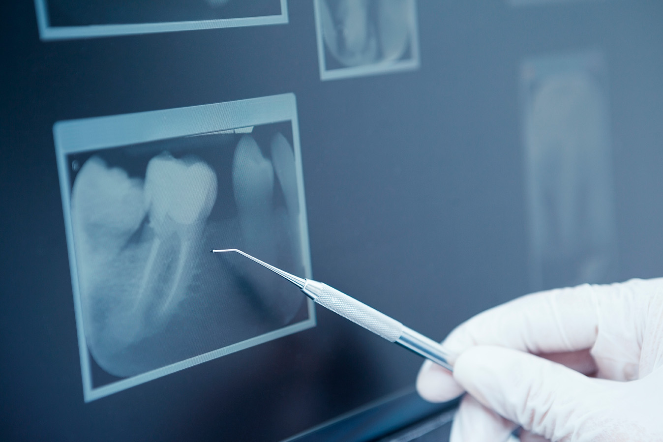 trauma dental endosevilla radiografía